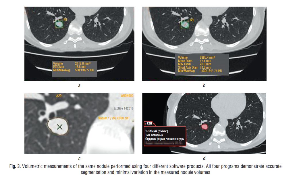 Automated lung nodule measurement comparison