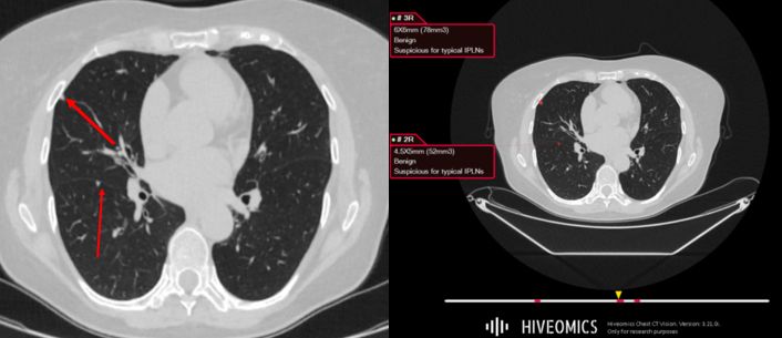 IPLN Model Illustration